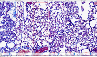 Fibrosis model image 2